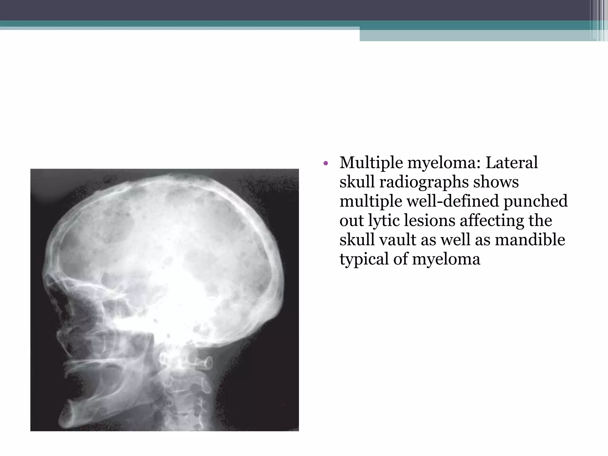 • Multiple myeloma: Lateral
skull radiographs shows
multiple well-defined punched
out lytic lesions affecting the
skull vault as well as mandible
typical of myeloma
 