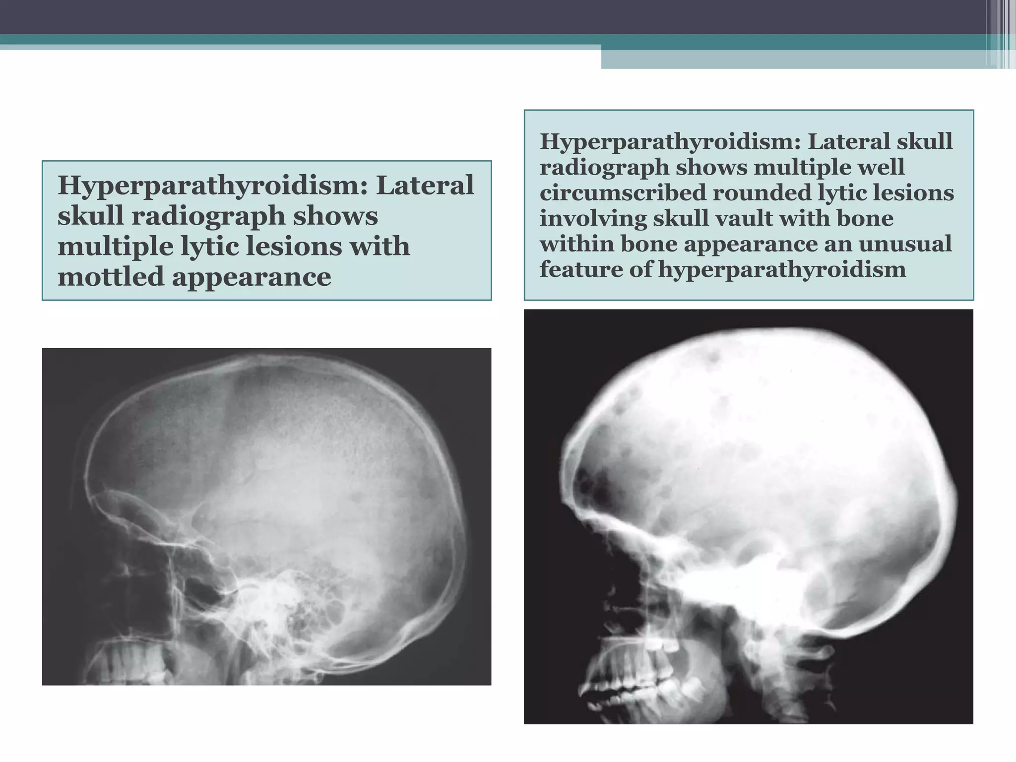 Hyperparathyroidism: Lateral
skull radiograph shows
multiple lytic lesions with
mottled appearance
Hyperparathyroidism: Lateral skull
radiograph shows multiple well
circumscribed rounded lytic lesions
involving skull vault with bone
within bone appearance an unusual
feature of hyperparathyroidism
 
