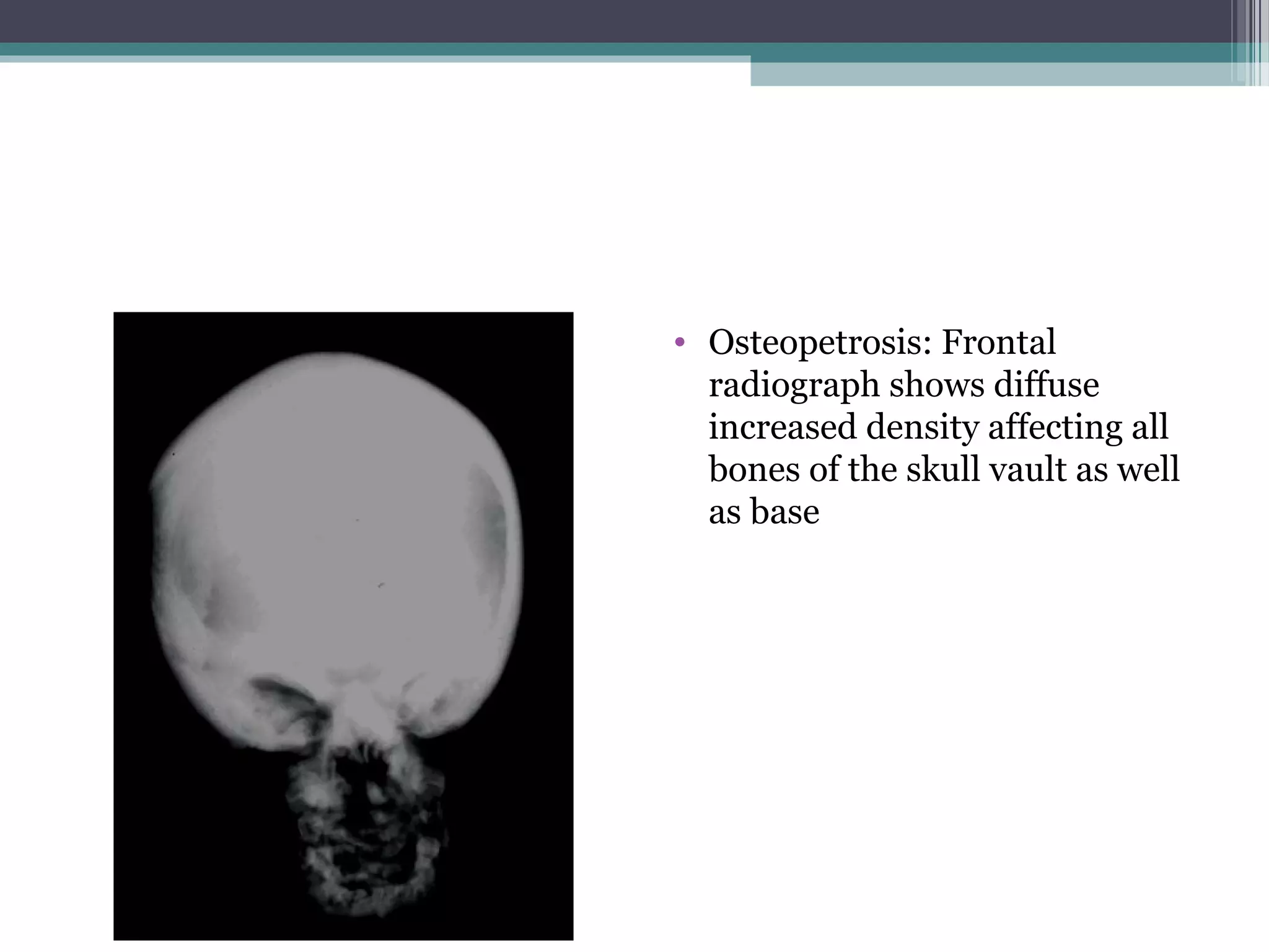 • Osteopetrosis: Frontal
radiograph shows diffuse
increased density affecting all
bones of the skull vault as well
as base
 