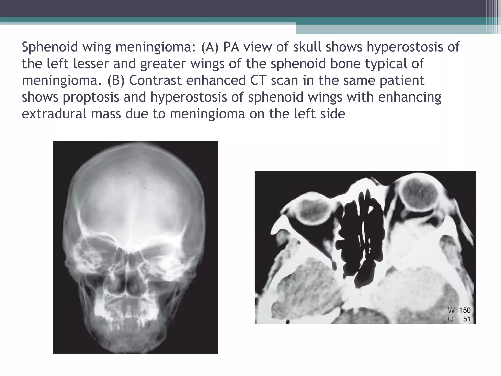 Sphenoid wing meningioma: (A) PA view of skull shows hyperostosis of
the left lesser and greater wings of the sphenoid bone typical of
meningioma. (B) Contrast enhanced CT scan in the same patient
shows proptosis and hyperostosis of sphenoid wings with enhancing
extradural mass due to meningioma on the left side
 