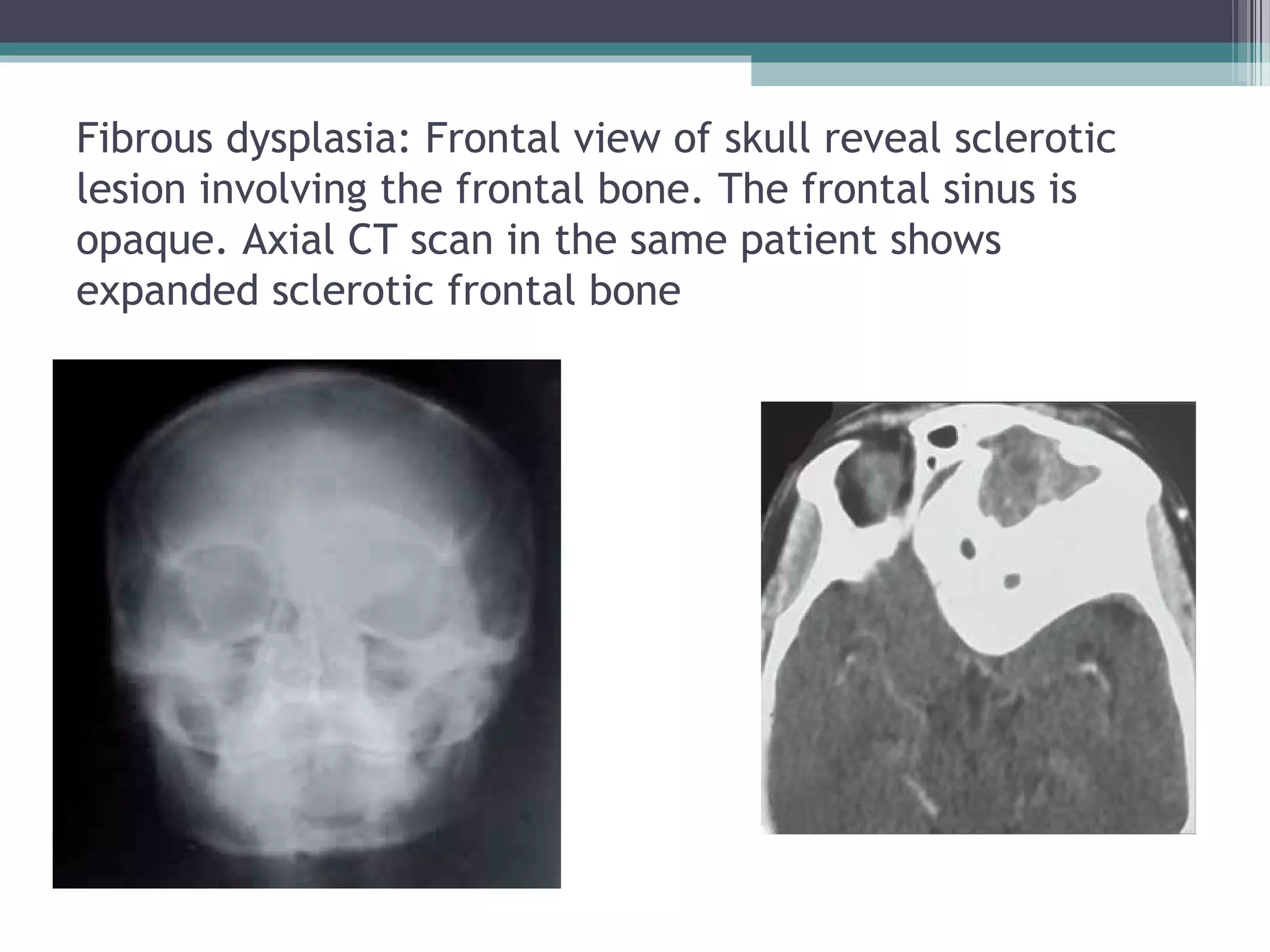 Fibrous dysplasia: Frontal view of skull reveal sclerotic
lesion involving the frontal bone. The frontal sinus is
opaque. Axial CT scan in the same patient shows
expanded sclerotic frontal bone
 
