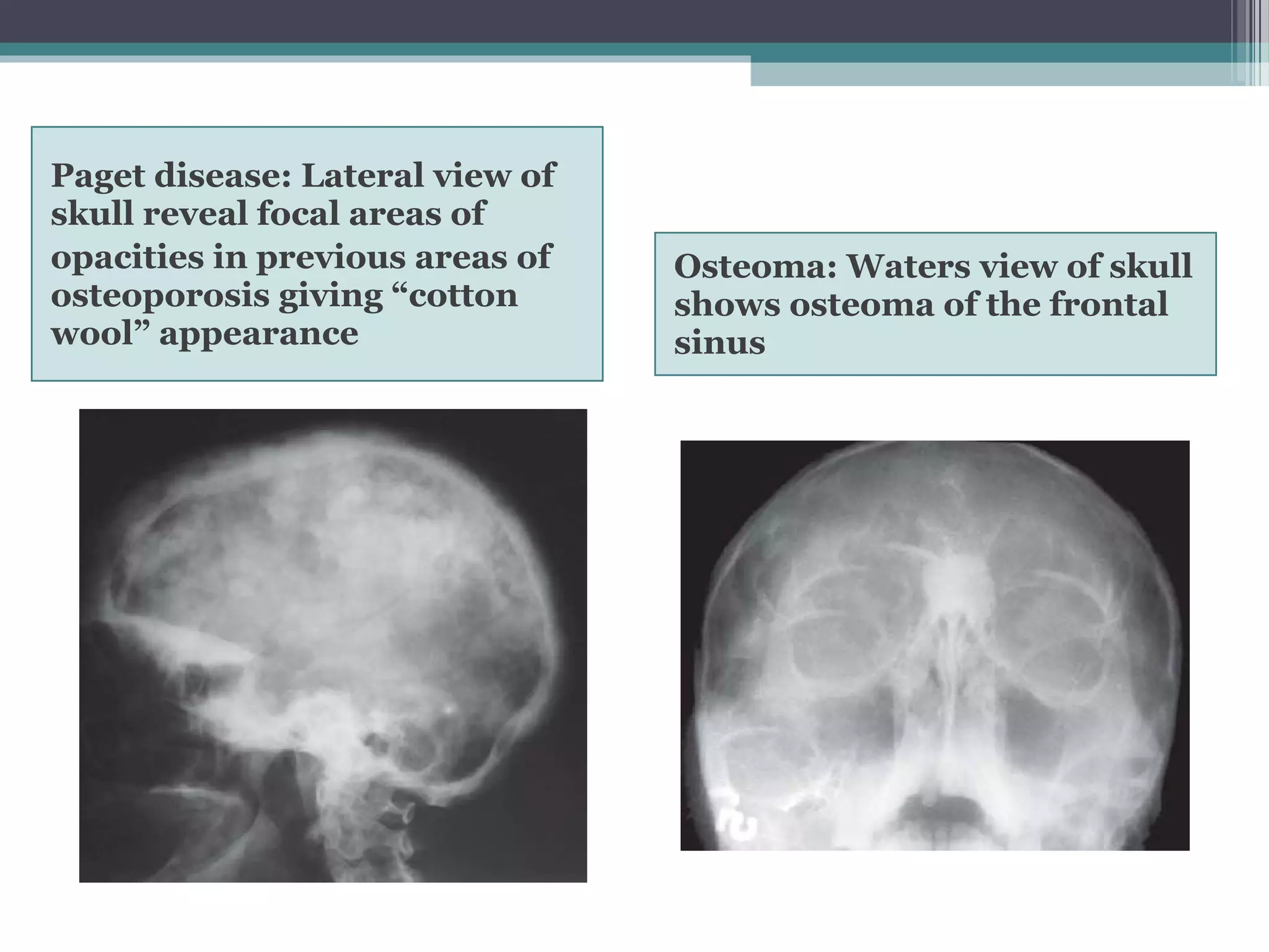 Paget disease: Lateral view of
skull reveal focal areas of
opacities in previous areas of
osteoporosis giving “cotton
wool” appearance
Osteoma: Waters view of skull
shows osteoma of the frontal
sinus
 