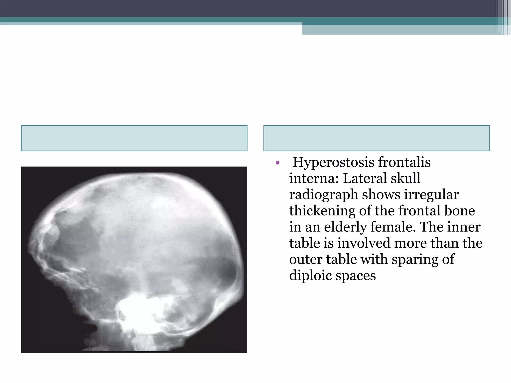 • Hyperostosis frontalis
interna: Lateral skull
radiograph shows irregular
thickening of the frontal bone
in an elderly female. The inner
table is involved more than the
outer table with sparing of
diploic spaces
 