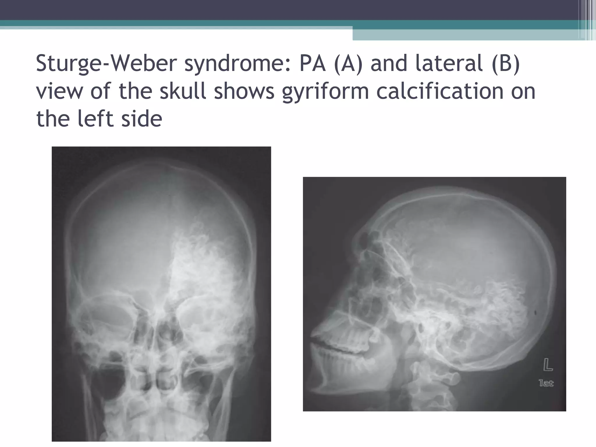 Sturge-Weber syndrome: PA (A) and lateral (B)
view of the skull shows gyriform calcification on
the left side
 