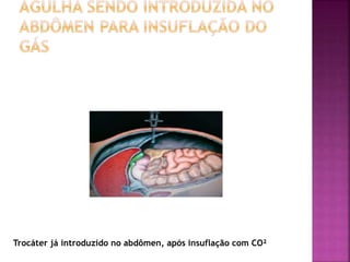 Trocáter já introduzido no abdômen, após insuflação com CO²
 