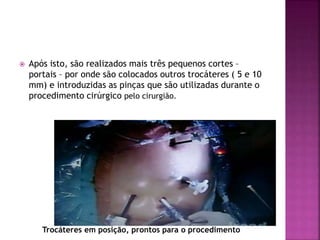  Após isto, são realizados mais três pequenos cortes –
portais – por onde são colocados outros trocáteres ( 5 e 10
mm) e introduzidas as pinças que são utilizadas durante o
procedimento cirúrgico pelo cirurgião.
Trocáteres em posição, prontos para o procedimento
 