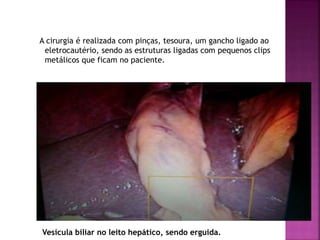 A cirurgia é realizada com pinças, tesoura, um gancho ligado ao
eletrocautério, sendo as estruturas ligadas com pequenos clips
metálicos que ficam no paciente.
Vesícula biliar no leito hepático, sendo erguida.
 