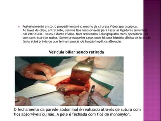  Posteriormente a isto, o procedimento é o mesmo da cirurgia Videolaparoscópica.
Ao invés de clips, entretanto, usamos fios inabsorvíveis para fazer as ligaduras (amarras)
das estruturas – vasos e ducto cístico. Não realizamos Colangiografia trans-operatória (RX
com contraste) de rotina. Somente naqueles casos onde há uma história clínica de icterícia
(amarelão) prévia ou que tenham provas de função hepática alteradas
Vesícula biliar sendo retirada
O fechamento da parede abdominal é realizado através de sutura com
fios absorvíveis ou não. A pele é fechada com fios de mononylon.
 