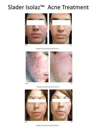 Slader Isolaz™ Acne Treatment
 