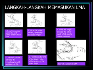 LANGKAH-LANGKAH MEMASUKAN LMA 1. Press the mask up against the hard palate. Note the flexed wrist. 2. Slide the mask inward, extending the index finger 3. Press the finger towards the other hand, which exerts counter-pressure 4. Advance the LMA cuff into the hypopharynx until resistance is felt 5. Hold the outer end of the airway tube while removing the index finger Correct position of LMA  