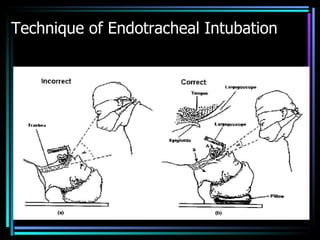 Technique of Endotracheal Intubation 