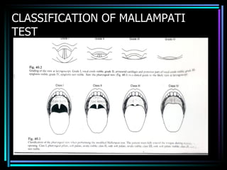 CLASSIFICATION OF MALLAMPATI TEST 