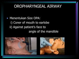 OROPHARYNGEAL AIRWAY Menentukan Size OPA: i) Coner of mouth to earlobe ii) Against patient’s face to  angle of the mandible 