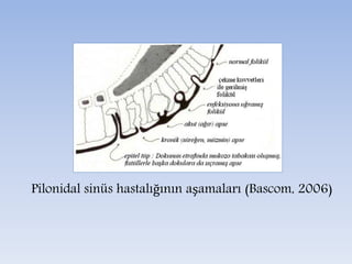PLONİDAL SİNÜS (KIL DÖNMESİ) TEDAVİSİ | PPTX