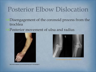 Posterior Elbow Dislocation
Disengagement of the coronoid process from the
 trochlea
Posterior movement of ulna and radius




                                                           http://lifeinthefastlane.com/2010/01/elbow-dislocation/



  http://www.medkaau.com/vb/showthread.php?t=7957&page=2
 