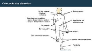 Colocação dos eletrodos
Fonte: Livro-texto.
B) Dor cervical
- bilateral
- unilateral
Neuralgia pós-herpética
- acima do dermátomo afetado
- através do dermátomo afetado
Dor no colo
Dor no quadril
Colo e membro fantasma
Tendinite
Doença vascular periférica
Ciática
Dor lombar ou
dismenorreia
Dor no ombro
 