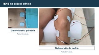 TENS na prática clínica
Dismenorreia primária
Osteoartrite de joelho
Fonte: Livro-texto.
Fonte: Livro-texto.
 
