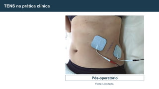 TENS na prática clínica
Pós-operatório
Fonte: Livro-texto.
 