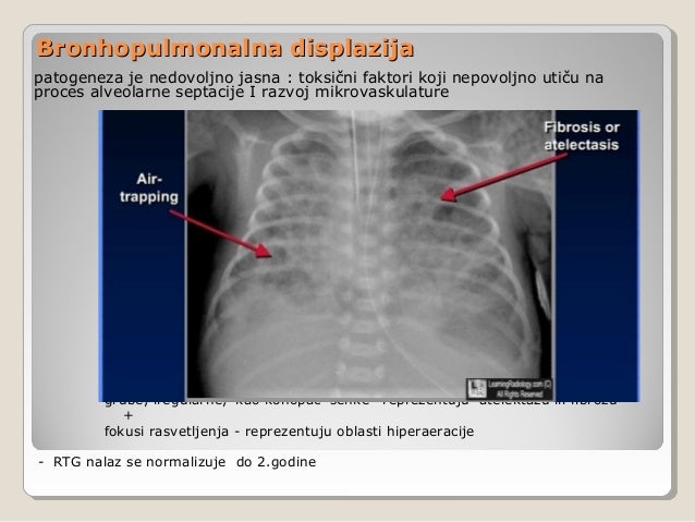 Hiperinflacija plućnog parenhima simptomi