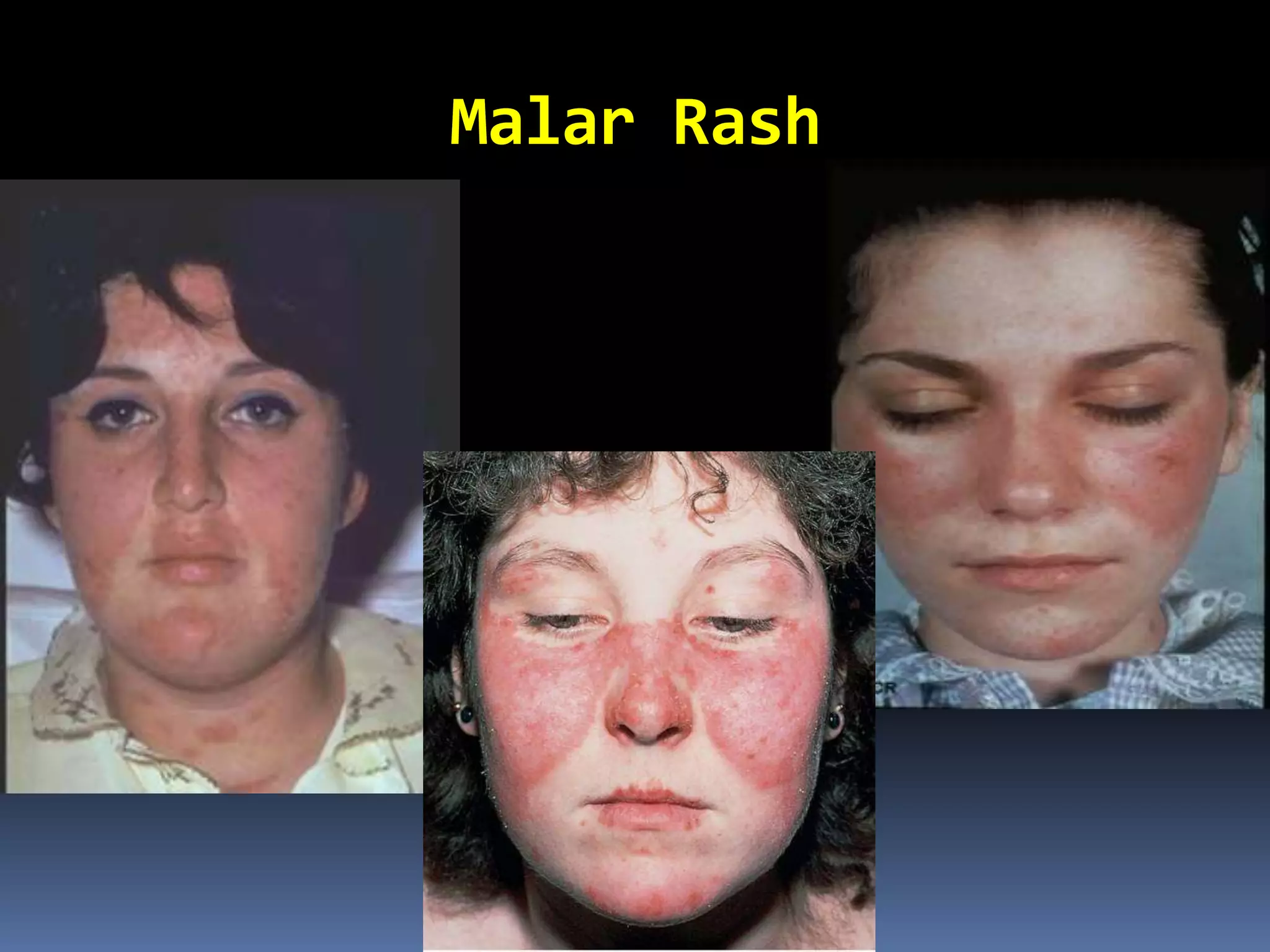 Malar Rash
 