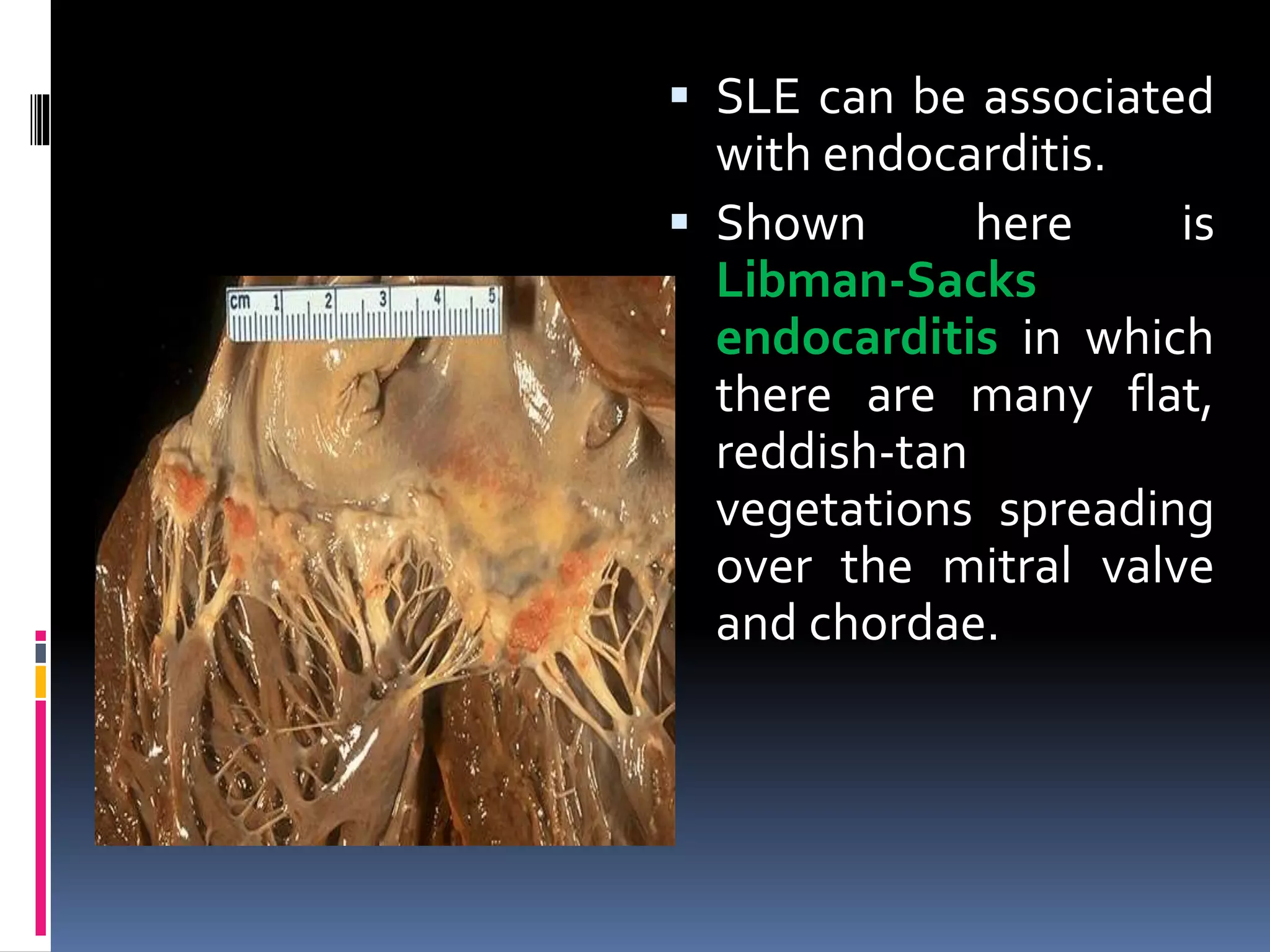  SLE can be associated
with endocarditis.
 Shown here is
Libman-Sacks
endocarditis in which
there are many flat,
reddish-tan
vegetations spreading
over the mitral valve
and chordae.
 