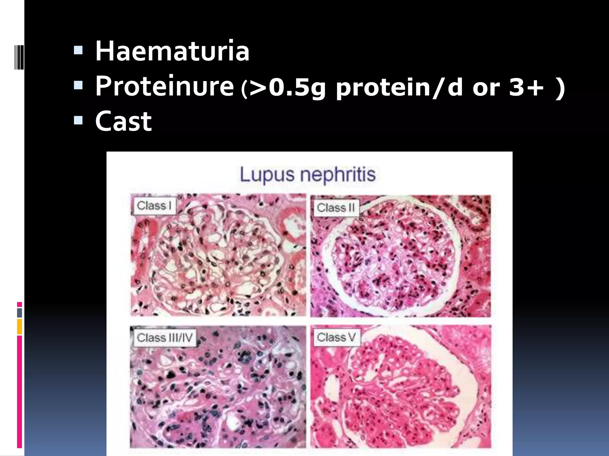  Haematuria
 Proteinure (>0.5g protein/d or 3+ )
 Cast
 