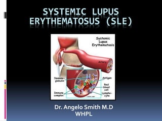 SYSTEMIC LUPUS
ERYTHEMATOSUS (SLE)
Dr. Angelo Smith M.D
WHPL
 