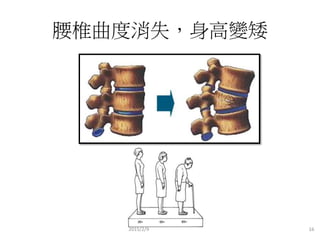 腰椎曲度消失，身高變矮
2015/2/9 16
 