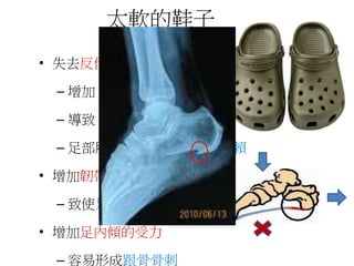 太軟的鞋子
• 失去反作用力
– 增加「膝蓋推進」力道
– 導致「前膝疼痛」症候群
– 足部肌肉的無力，並形成依賴
• 增加韌帶受力
– 致使足弓塌陷
• 增加足內傾的受力
– 容易形成跟骨骨刺
 