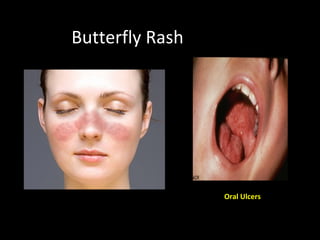 Systemic lupus erythematosis & Kawasaki disease | PPT