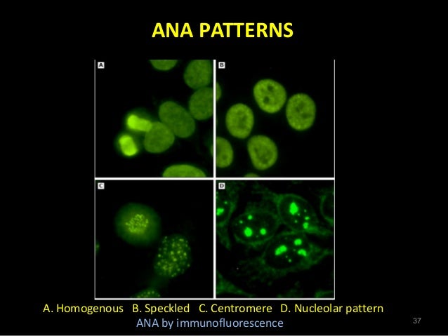 Systemic Lupus Erythematosis Kawasaki Disease Best Ana Nucleolar Pattern Systemic Lupus Erythematosis Kawasaki Disease Best Ana Nucleolar Pattern