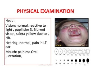 PHYSICAL EXAMINATION
Head:
Vision: normal, reactive to
light , pupil size 3, Blurred
vision, sclera yellow due to L
Hb.
Hearing; normal, pain in LT
ear
Mouth: painless Oral
ulceration,
jamilah saad alqahtani 20
 