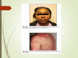 Sle Patterns Systemic Lupus Erythematosis - SLE -Etiopathogenesis, Clinical features ...