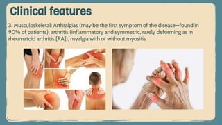 3. Musculoskeletal: Arthralgias (may be the first symptom of the disease—found in
90% of patients), arthritis (inflammatory and symmetric, rarely deforming as in
rheumatoid arthritis [RA]), myalgia with or without myositis
Clinical features
 