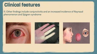 11. Other findings include conjunctivitis and an increased incidence of Raynaud
phenomenon and Sjögren syndrome
Clinical features
 