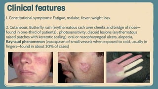 1. Constitutional symptoms: Fatigue, malaise, fever, weight loss.
2. Cutaneous: Butterfly rash (erythematous rash over cheeks and bridge of nose—
found in one-third of patients) , photosensitivity, discoid lesions (erythematous
raised patches with keratotic scaling), oral or nasopharyngeal ulcers, alopecia,
Raynaud phenomenon (vasospasm of small vessels when exposed to cold, usually in
fingers—found in about 20% of cases)
Clinical features
 