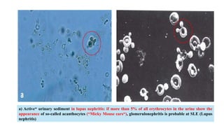 a) Active“ urinary sediment in lupus nephritis: if more than 5% of all erythrocytes in the urine show the
appearance of so-called acanthocytes (“Micky Mouse ears“), glomerulonephritis is probable at SLE (Lupus
nephritis)
 