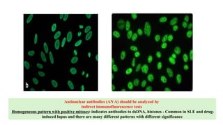 Antinuclear antibodies (AN A) should be analyzed by
indirect immunofluorescence tests
Homogeneous pattern with positive mitoses: indicates antibodies to dsDNA, histones - Common in SLE and drug-
induced lupus and there are many different patterns with different significance
 