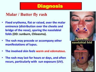 Lupus Rash Distribution SLE & APS for undergraduates: diagnosis & treatment. | PDF