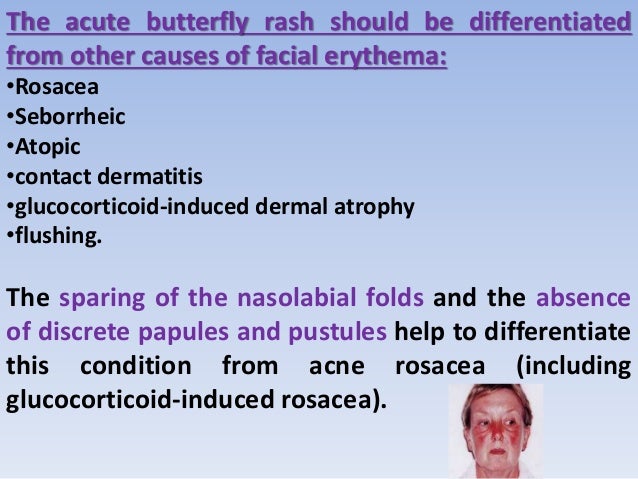 Acne Rosacea Vs Lupus Rash Lupus Misdiagnosis Diseases That Can Mimic