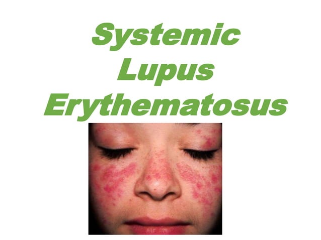 Systemic Lupus Erythematosus -SLE PT2.ppt