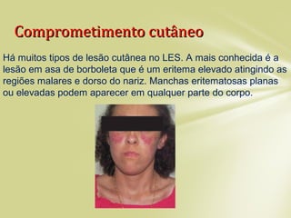 Comprometimento cutâneoComprometimento cutâneo
Há muitos tipos de lesão cutânea no LES. A mais conhecida é a
lesão em asa de borboleta que é um eritema elevado atingindo as
regiões malares e dorso do nariz. Manchas eritematosas planas
ou elevadas podem aparecer em qualquer parte do corpo.
 