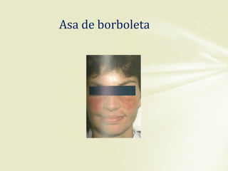 Asa de borboleta
 