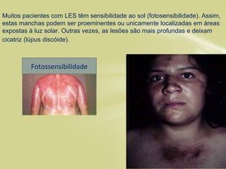 Muitos pacientes com LES têm sensibilidade ao sol (fotosensibilidade). Assim,
estas manchas podem ser proeminentes ou unicamente localizadas em áreas
expostas à luz solar. Outras vezes, as lesões são mais profundas e deixam
cicatriz (lúpus discóide).
fotosensibilidadeFotossensibilidade
 