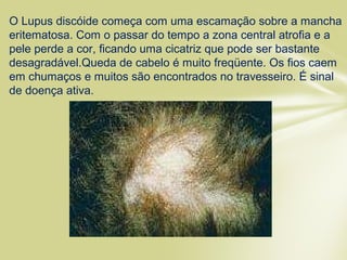 O Lupus discóide começa com uma escamação sobre a mancha
eritematosa. Com o passar do tempo a zona central atrofia e a
pele perde a cor, ficando uma cicatriz que pode ser bastante
desagradável.Queda de cabelo é muito freqüente. Os fios caem
em chumaços e muitos são encontrados no travesseiro. É sinal
de doença ativa.
 