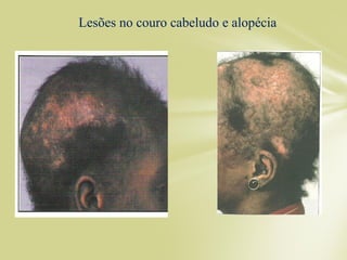 Lesões no couro cabeludo e alopécia
 