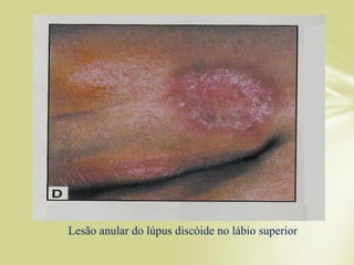 Lesão anular do lúpus discóide no lábio superior
 