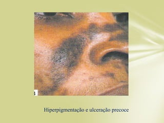 Hiperpigmentação e ulceração precoce
 