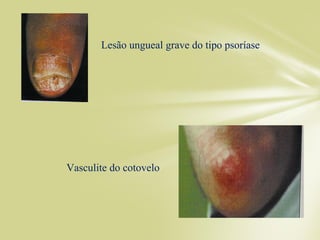 Lesão ungueal grave do tipo psoríase
Vasculite do cotovelo
 