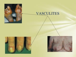 VASCULITES
 